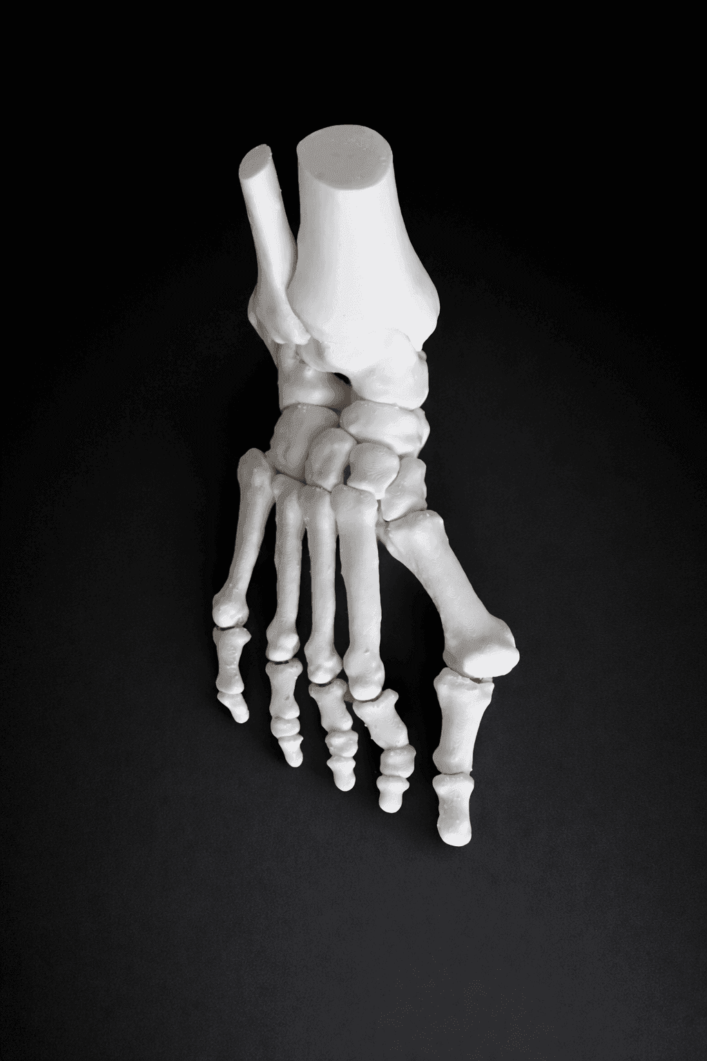 2 Pathology in 1 Foot – Hallux Valgus & Pes Planus – Bone Model – Mobile Joints