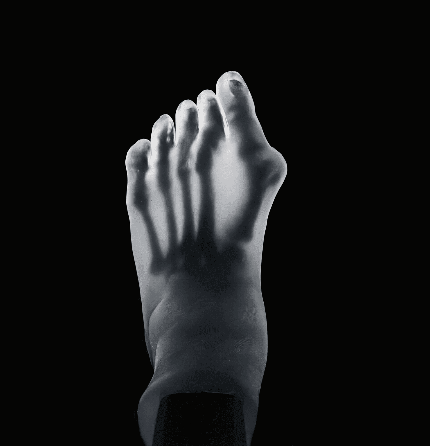 2 Pathology in 1 Foot – Hallux Valgus & Pes Planus – Transparent Skin – Radioopaque Bone – Mobile Joints