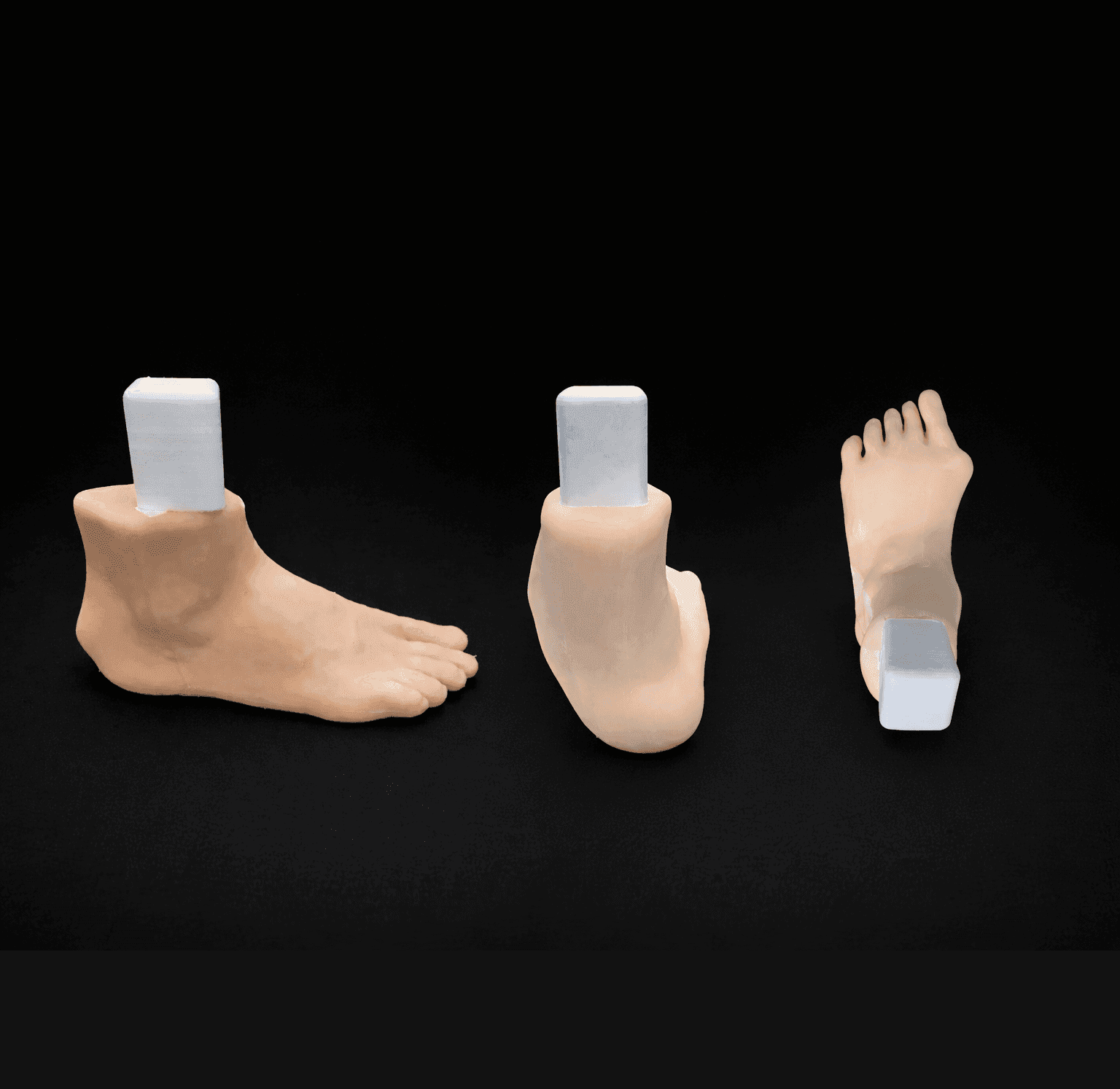3 Pathology in 1 Foot – Hallux Valgus & Pes Planus & Haglund – Radioopaque Bone – Opaque Skin – Mobile Joints