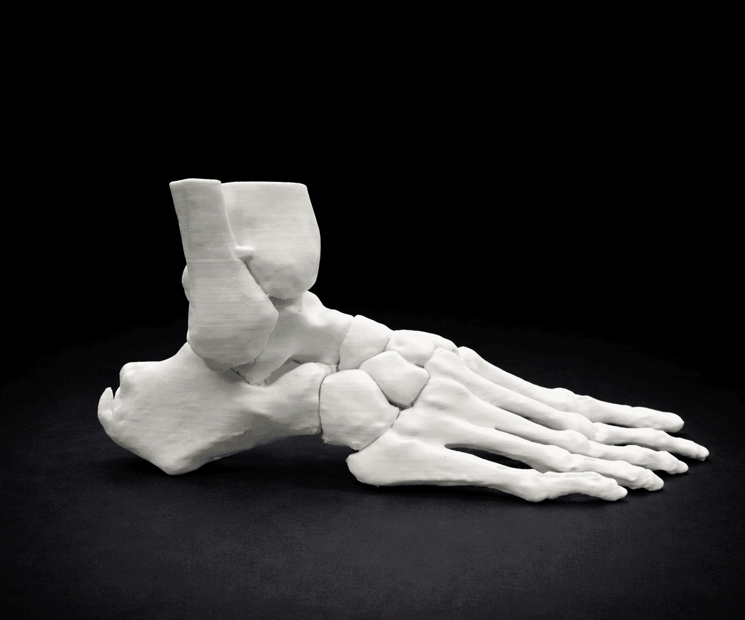 Haglund Deformity & Insertional Achilles Tendinopathy – Bone Model