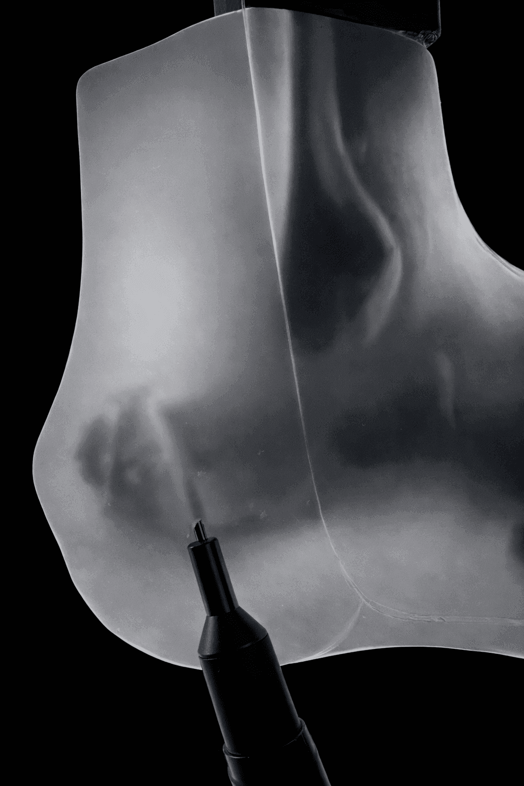 Haglund Deformity & Insertional Achilles Tendinopathy – Transparent Skin – Radioopaque Black Bone