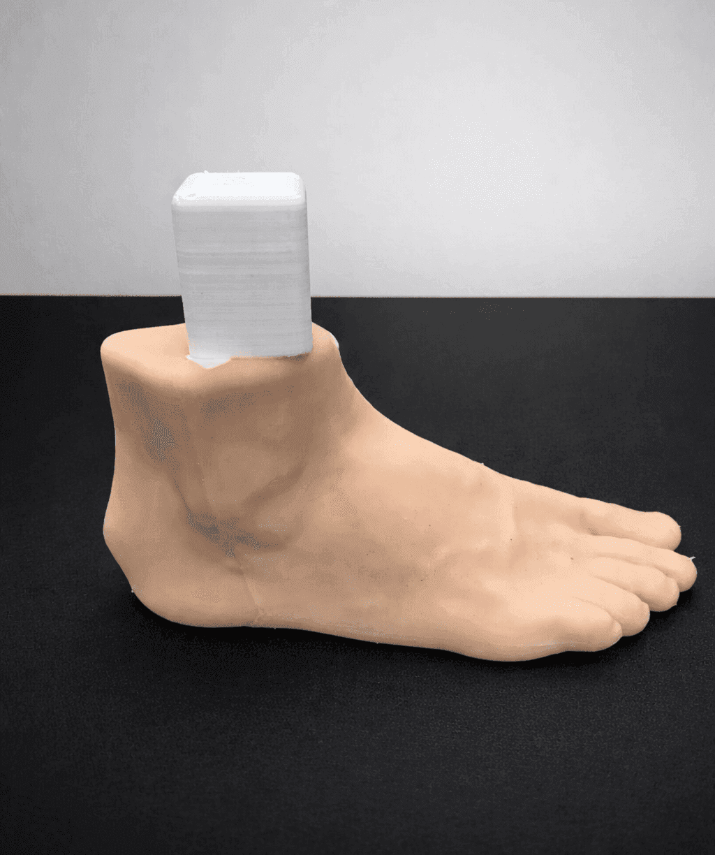 Haglund Deformity & Insertional Achilles Tendinopathy – Radioopaque Bone – Opaque Skin