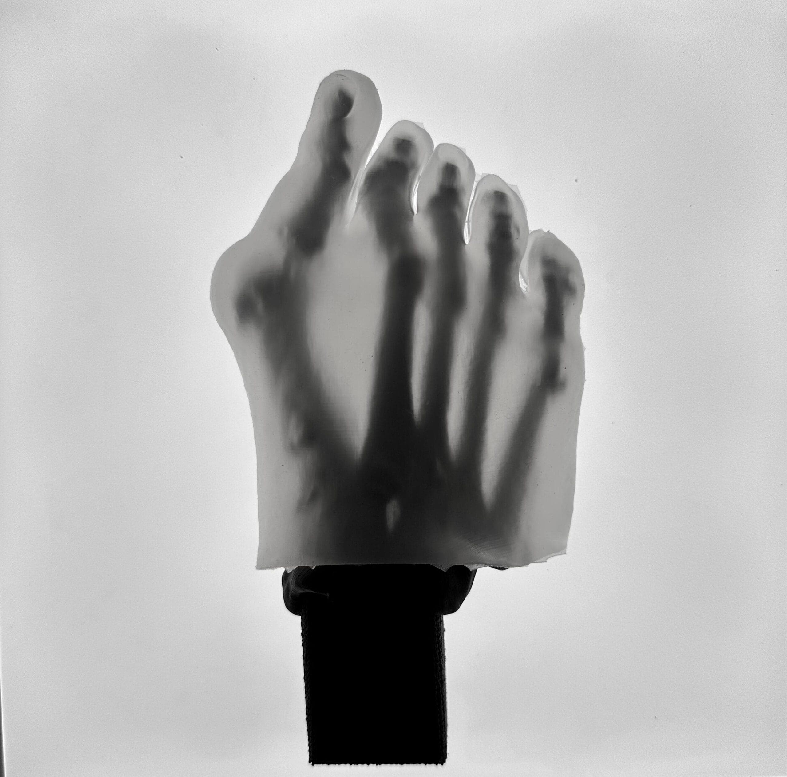 Hallux Valgus – Transparent Skin – Radiolucent Black Bone – Mobile Joints