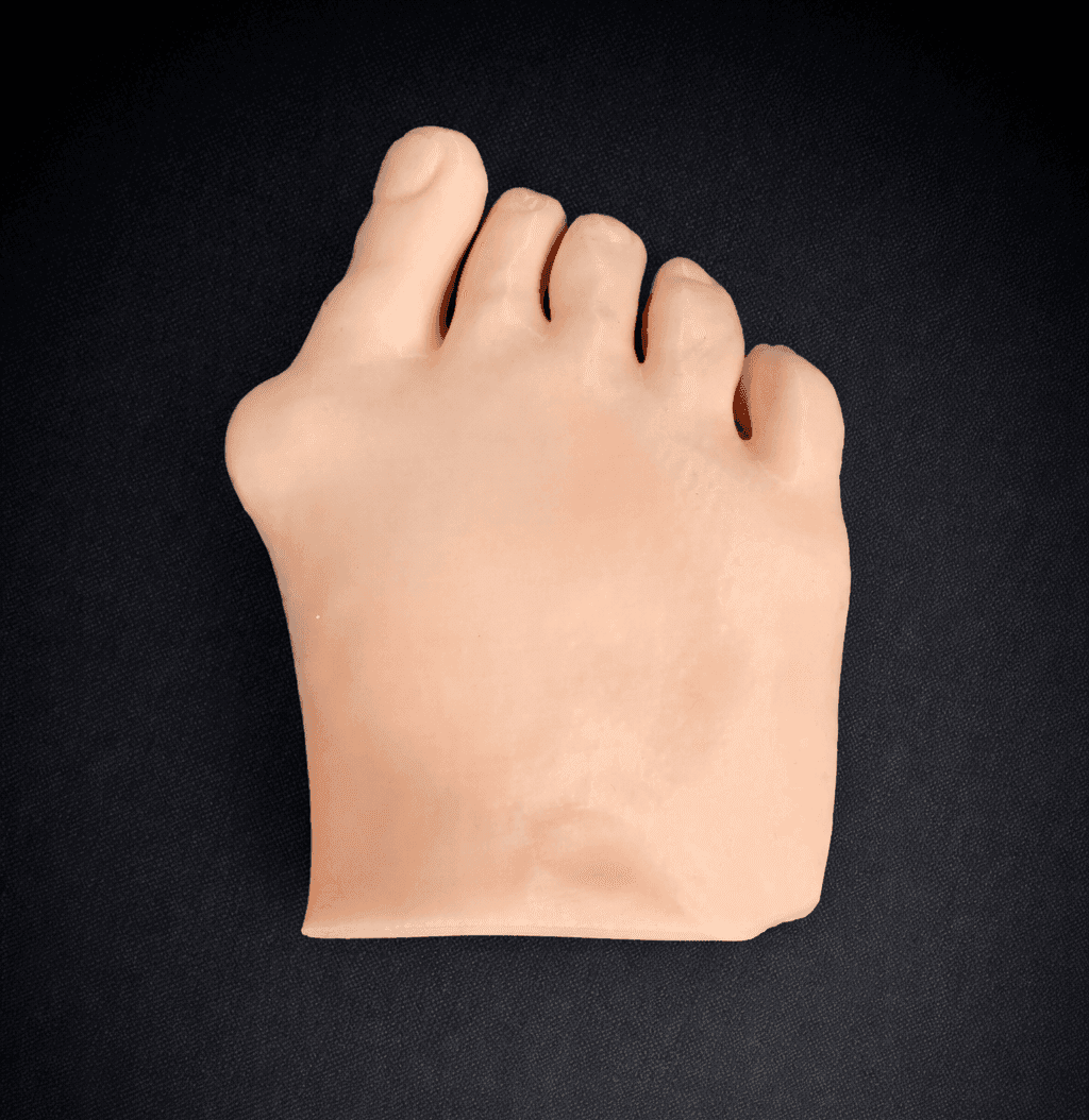 Modular Skin Part Compatible with Hallux Valgus Bone Model (Opaque)