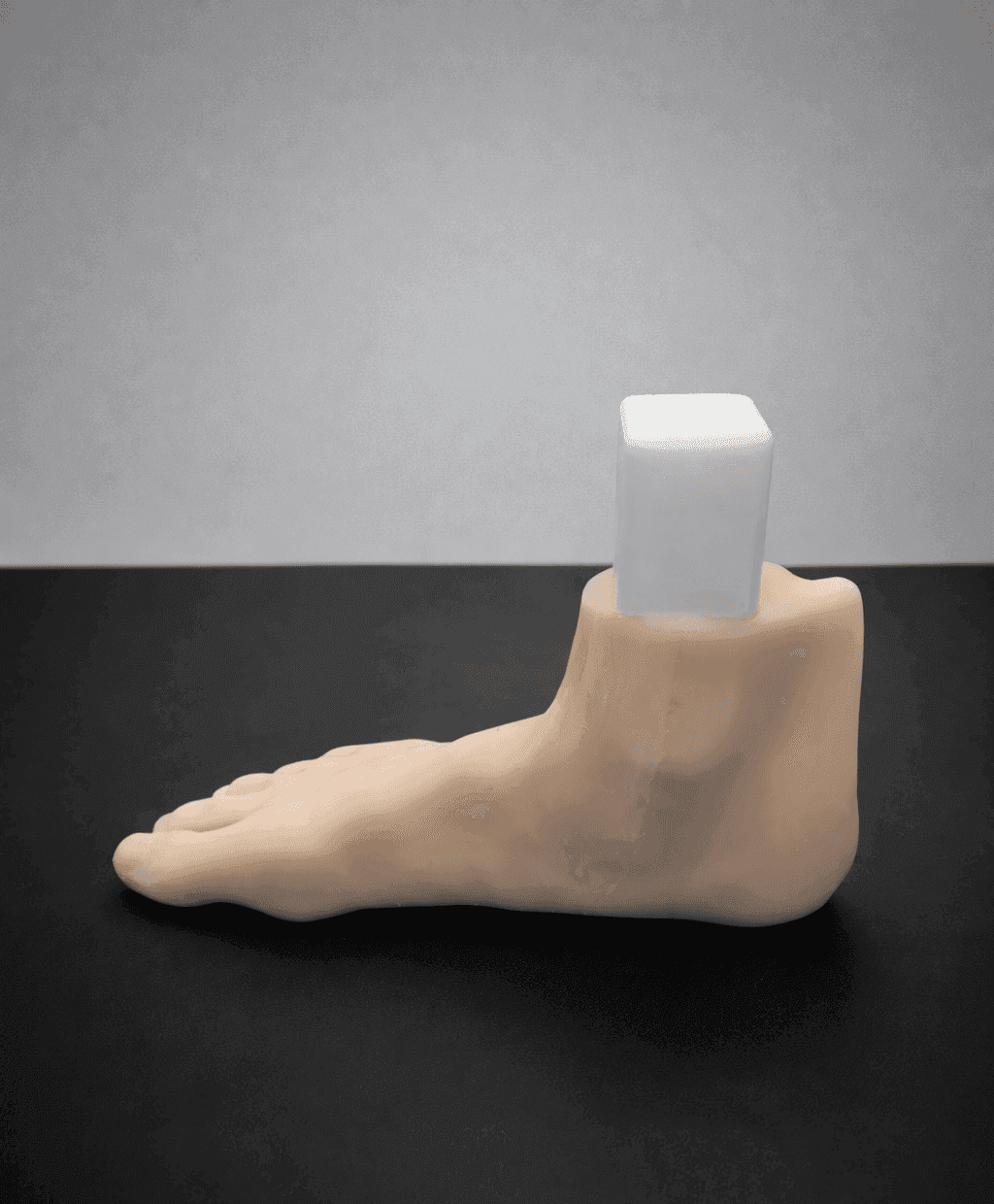Pes Planus – Radioopaque Bone – Opaque Skin – Mobile Joints (including Evans & Cotton wedges)
