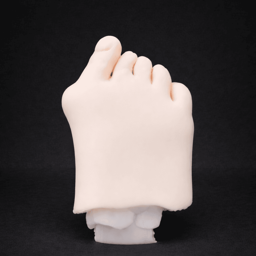 Hallux Valgus - Opaque Skin - Radioopaque Bone