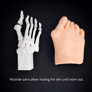 Hallux Valgus - Opaque Skin - Radioopaque Bone - Mobile Joints