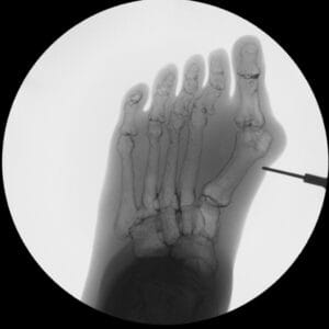 Hallux Valgus - Transparent Skin - Radioopaque Black Bone