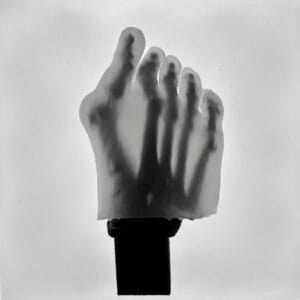 Hallux Valgus - Transparent Skin - Radioopaque Black Bone