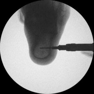 Pes Planus - Radioopaque Bone - Opaque Skin