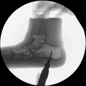 Pes Planus - Radioopaque Bone - Opaque Skin