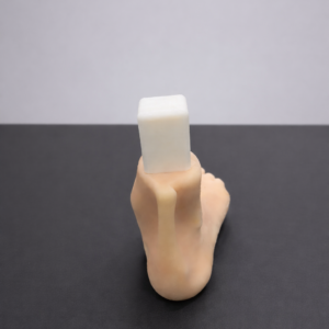 Pes Planus - Radioopaque Bone - Opaque Skin