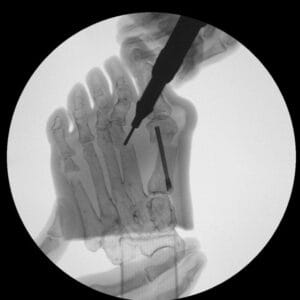 Hallux Valgus - Opaque Skin - Radioopaque Bone - Mobile Joints