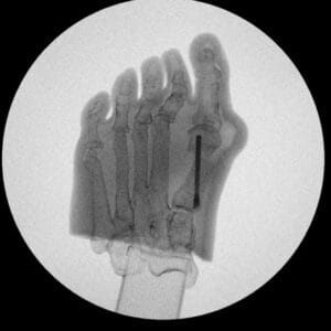 Hallux Valgus - Opaque Skin - Radioopaque Bone - Mobile Joints
