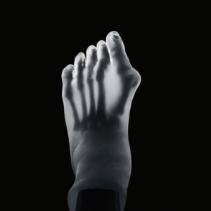 2 Pathology in 1 Foot - Hallux Valgus & Pes Planus - Transparent Skin - Radiolucent Bone