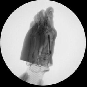 Hallux Valgus - Opaque Skin - Radioopaque Bone - Mobile Joints