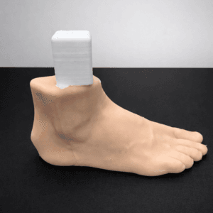 Haglund - Zadek Osteotomy - Radioopaque Bone - Opaque Skin