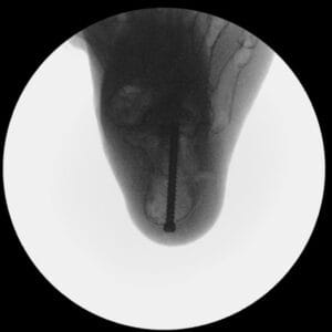 Pes Planus - Radioopaque Bone - Opaque Skin - Mobile Joints (including Evans & Cotton wedges)