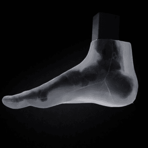 2 Pathology in 1 Foot - Hallux Valgus & Pes Planus - Transparent Skin - Radiolucent Bone