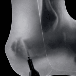 Haglund Deformity & Insertional Achilles Tendinopathy - Transparent Skin - Radioopaque Black Bone