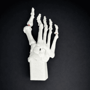 Hallux Valgus Bone Model - Mobile Joints
