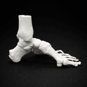 Pes Cavus - Bone Model