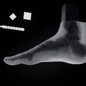 Pes Planus - Transparent Skin - Radiolucent Black Bone - Mobile Joints (including Evans & Cotton wedges)