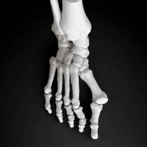 2 Pathology in 1 Foot – Hallux Valgus & Pes Planus – Bone Model - Mobile Joints