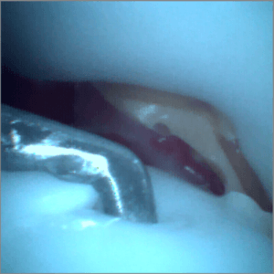 Talus OCD - Ankle Arthroscopy Trainer