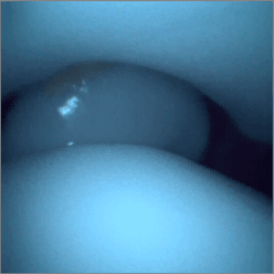 Talus OCD - Ankle Arthroscopy Trainer