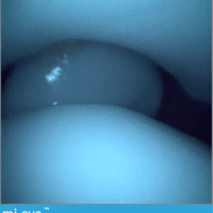 Talus OCD - Ankle Arthroscopy Trainer